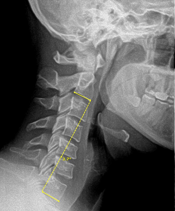 F1 Technique for New Patients